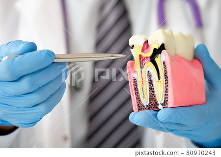 Dentist doctor showing with pen caries on dummy tooth closeup 80910243