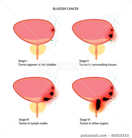 Bladder cancer stages Bladder cancer stages 80928583