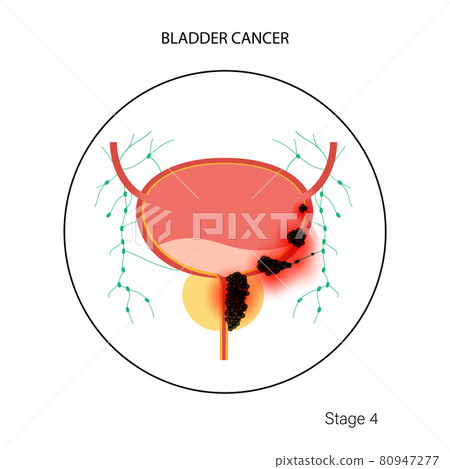 Bladder cancer stages Bladder cancer stages 80947277