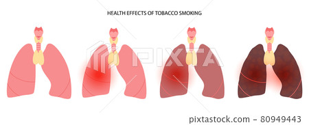 Tobacco smoking effect 80949443