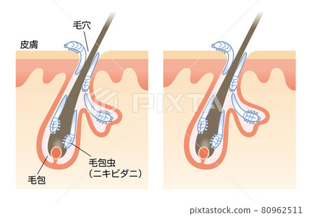 Mange,毛囊蠕形蟎,皮膚,毛孔,髮根,插圖 Mange,毛囊蠕形蟎,皮膚,毛孔,髮根,插圖 80962511