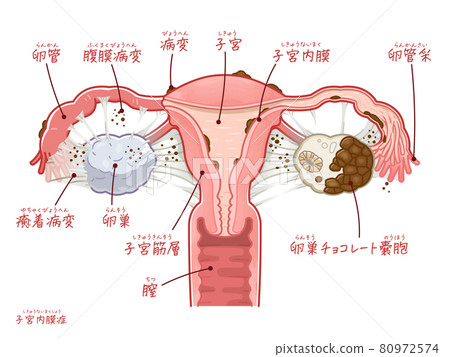 Illustration of the uterus, ovaries, and fallopian tubes with endometriosis (with text) 80972574