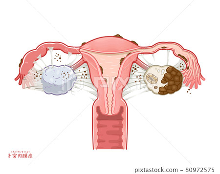 子宮、卵巢和輸卵管與子宮內膜異位症的插圖 80972575