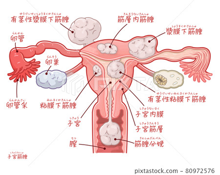 Illustration of uterine, ovary, and fallopian tubes of uterine fibroids (with text) Illustration of uterine, ovary, and fallopian tubes of uterine fibroids (with text) 80972576