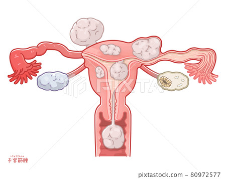 Illustration of the uterus, ovaries, and fallopian tubes of uterine fibroids 80972577