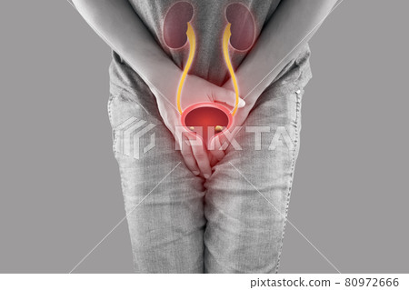 Bladder stones 80972666
