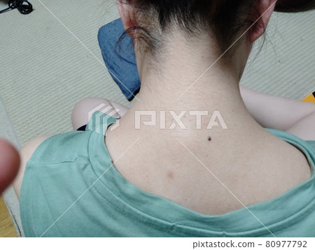 脖子根部有痣 80977792