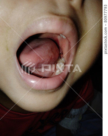 兒童口腔潰瘍 80977793