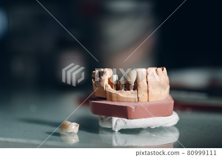Dental layout of the human jaw with teeth and implants. 80999111