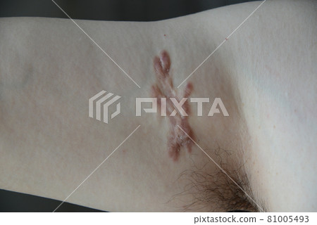 A photo of a man's arm that has grown in scars 24 years after suffering from chickenpox without crushing the blisters 81005493