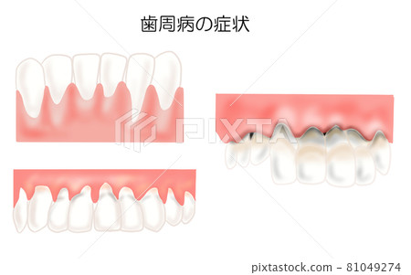 Periodontal disease symptoms 3 illustrations 81049274