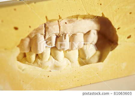 石膏牙模型牙齒圖像 81063603