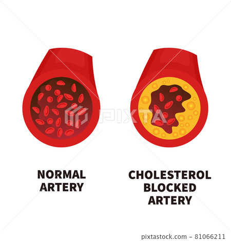 Normal and narrowed artery cross section illustration Normal and narrowed artery cross section illustration 81066211