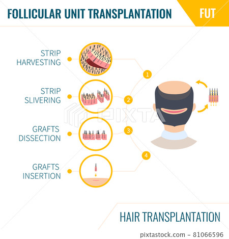 Hair transplantation by FUT method in men 81066596