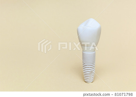 Dental implant. Dental implant model of artificial tooth Dental implant. Dental implant model of artificial tooth 81071798