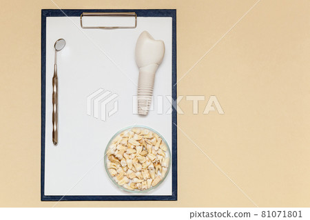 Dental implant. Dental implant model of artificial tooth Dental implant. Dental implant model of artificial tooth 81071801