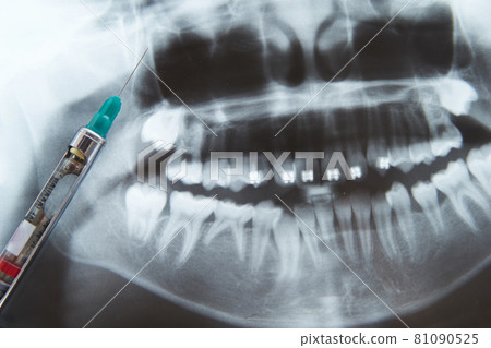 X 光和牙科麻醉 牙科圖像 81090525