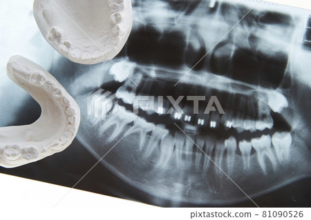 X 光和石膏牙型牙科圖像 X 光和石膏牙型牙科圖像 81090526