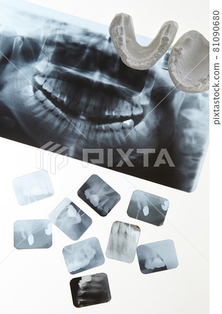 X 光和石膏牙型牙科圖像 81090680