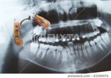 Partial denture bridge and X-ray photo Dental image Partial denture bridge and X-ray photo Dental image 81090978