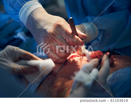 Surgeon removing extra fat and skin from patient abdomen. 81103619