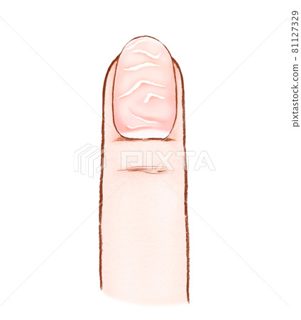 Rough nails and finger illustrations with bumpy nails Rough nails and finger illustrations with bumpy nails 81127329
