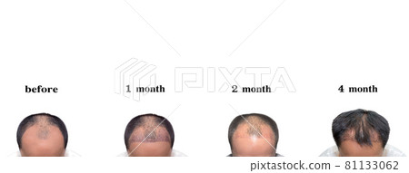 Hair transplantation surgery steps. Patient before and after the procedure. 81133062