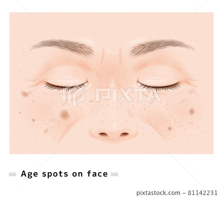 Amyloid plaque Senior Middle-aged Elderly Law Line Nose Stain Wrinkles Female Face Eyes Closed Aging Real Illustration Amyloid plaque Senior Middle-aged Elderly Law Line Nose Stain Wrinkles Female Face Eyes Closed Aging Real Illustration 81142231