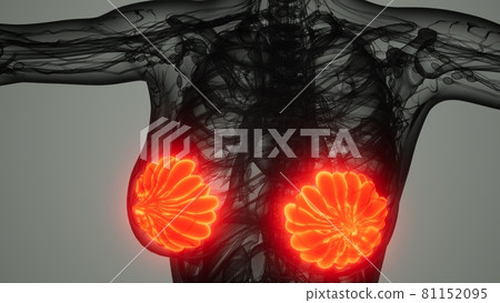 medical scan of Woman Breast Cancer 81152095