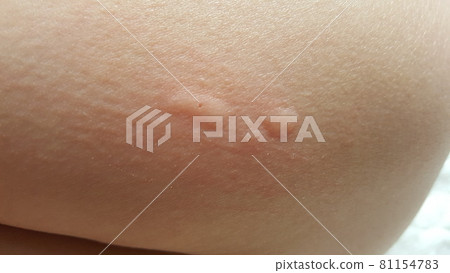 多次昆蟲叮咬 81154783