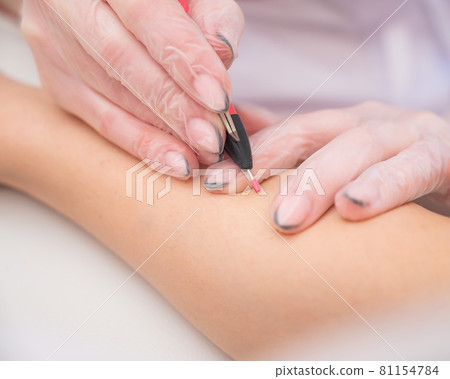 The doctor makes electro epilation of the woman's hands in the salon. Close-up of hardware removal of unwanted hair forever The doctor makes electro epilation of the woman's hands in the salon. Close-up of hardware removal of unwanted hair forever 81154784