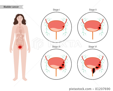 Bladder cancer stages Bladder cancer stages 81207690