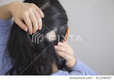 斑禿女性 斑禿女性 81209697