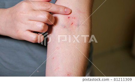 Woman points out scratches and bites on her arm 81211309
