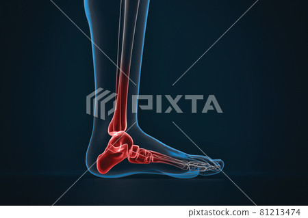 Arthritis of ankle. X-ray of foot. Lateral view 81213474