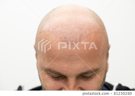 man after hair implant therapy man after hair implant therapy 81230280