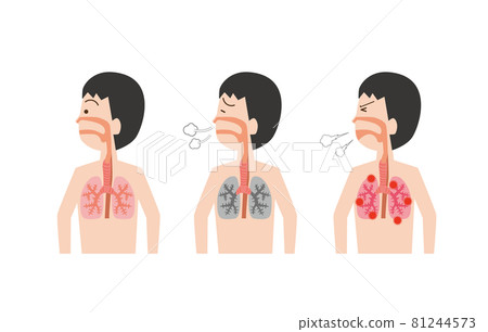Set illustration of lung condition 81244573