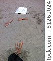 A man buried in a sandy beach 81261024