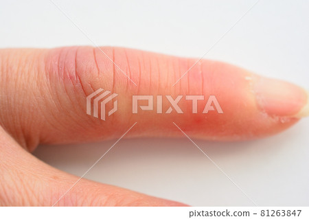 左手小指凍傷腫了 81263847