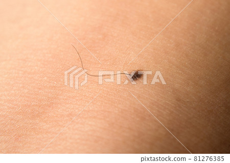 Image of hair growing from a mole Image of hair growing from a mole 81276385