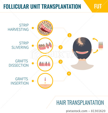 Hair transplantation by FUT method in women 81301620