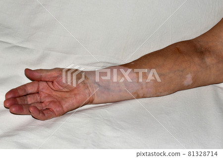 Woman's right hand damaged by vitiligo disease, palm up. 81328714