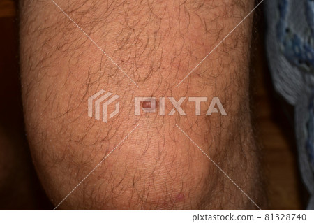 Round papilloma on the knee of a man. Round papilloma on the knee of a man. 81328740