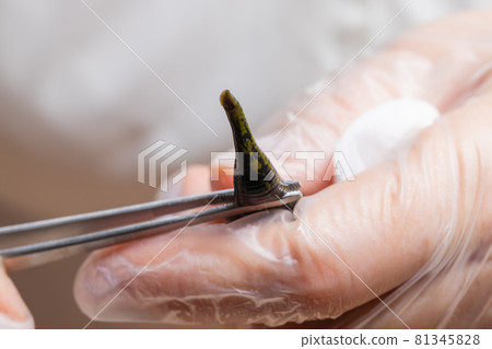 Traditional alternative medicine - doctor doing procedure of hirudotherapy for young woman. 81345828