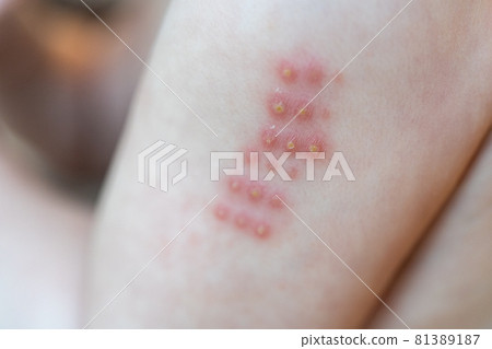 BCG injected baby's arm 81389187