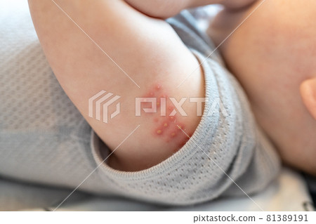 BCG injected baby's arm BCG injected baby's arm 81389191