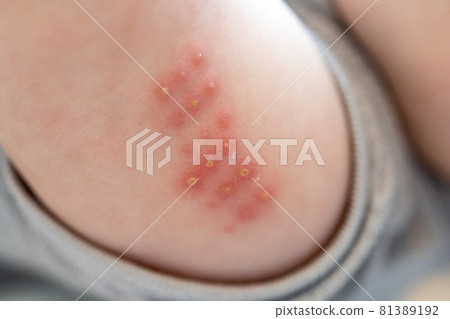 BCG injected baby's arm 81389192