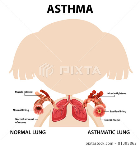 Asthma diagram with normal lung and asthmatic lung Asthma diagram with normal lung and asthmatic lung 81395862