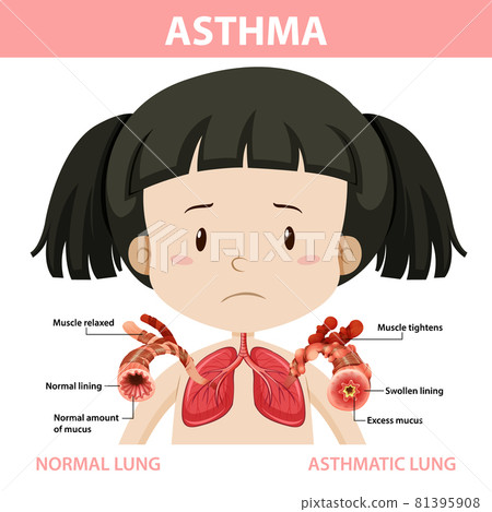 Asthma diagram with normal lung and asthmatic lung 81395908