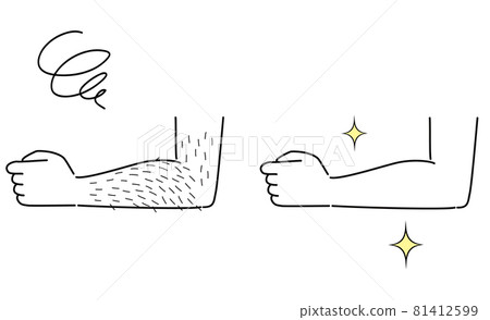 毛茸茸的手臂和美麗的脫毛前後的手臂 81412599